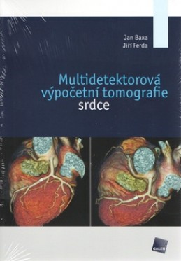 Multidetektorová výpočetní tomografie srdce - Jan Baxa; Jiří Ferda