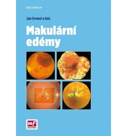 Makulární edémy